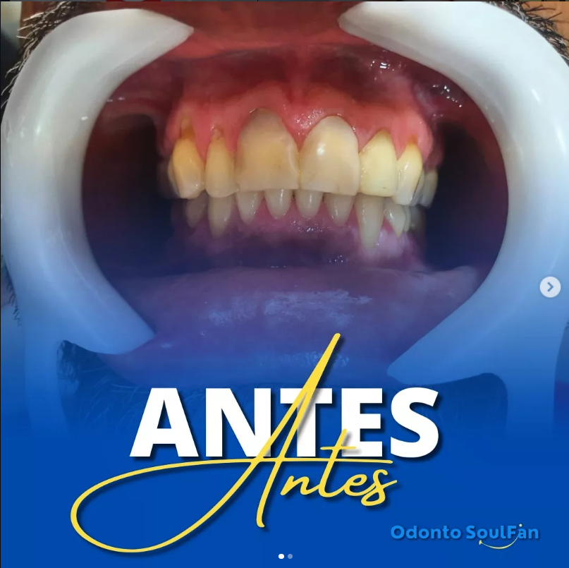 Antes — Facetas de Resina